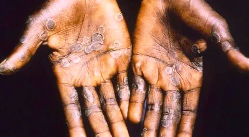 Monkey pox. (photo : ANTARA/CDC)