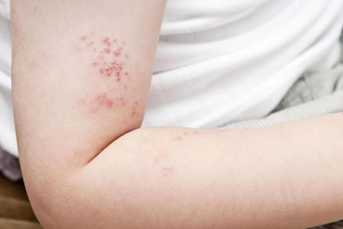 Herpes Zoster. (photo : Ist)